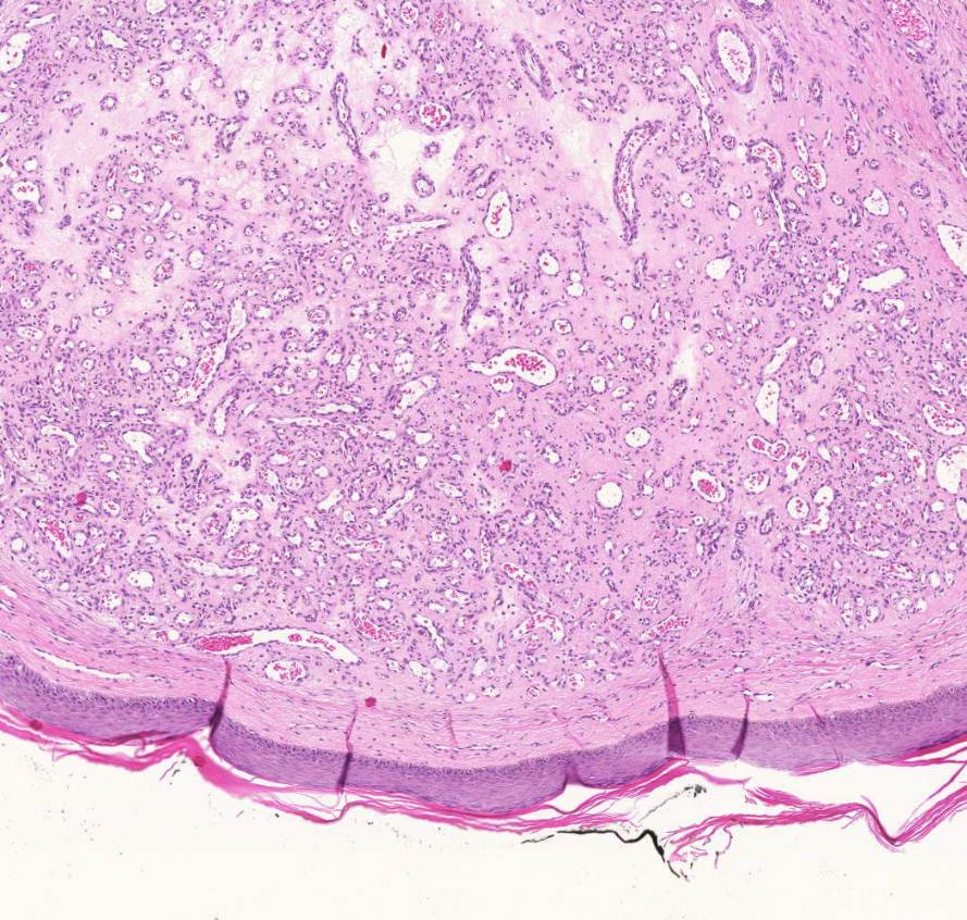 haemangioma capillare cutis0