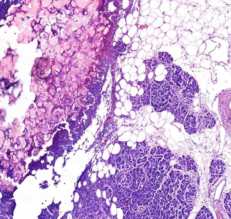 Lliponecrosis pancreatis 0