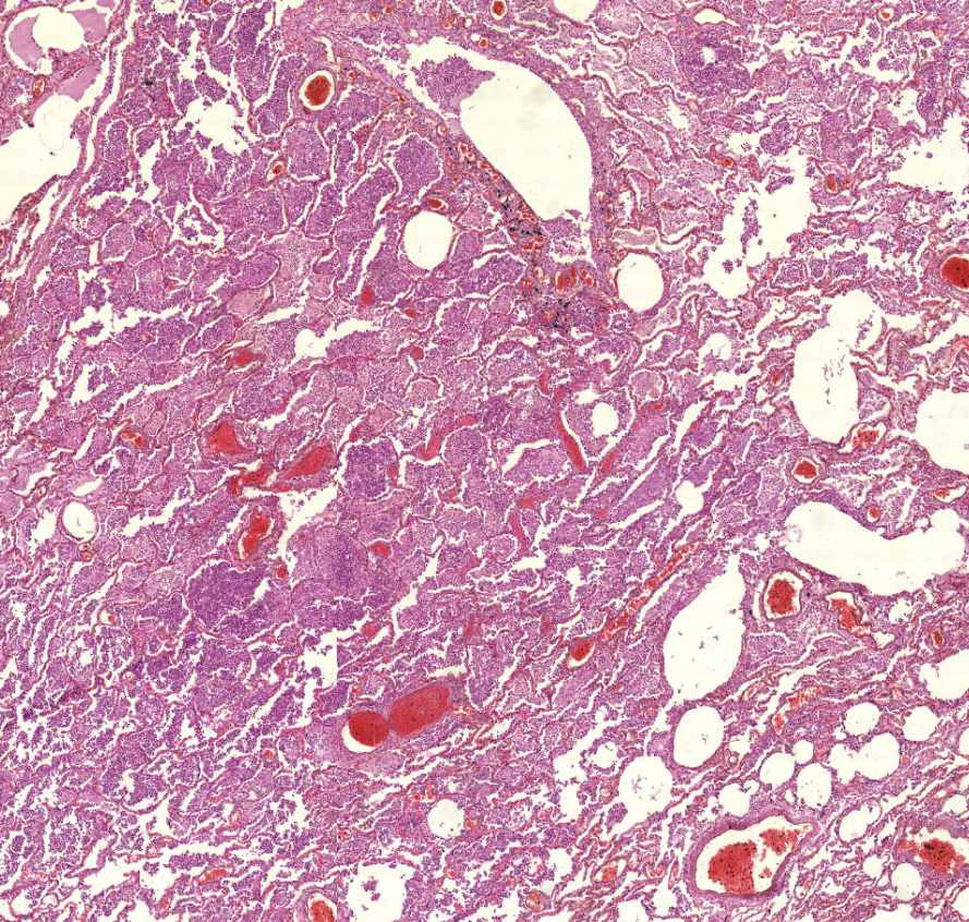 bronchopneumonia-bronchus