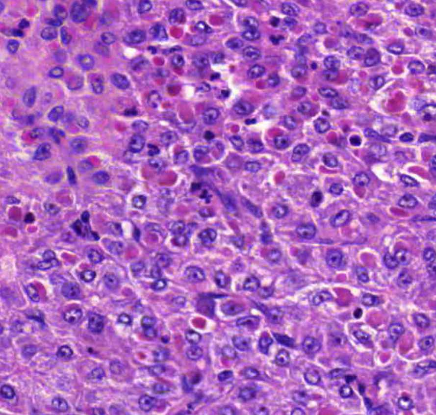 Carcinoma hepatocellulare osztódó