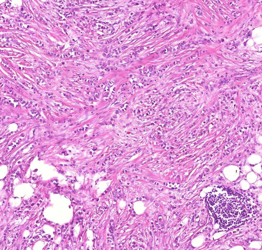 carcinoma lobulare invasivum mammae0