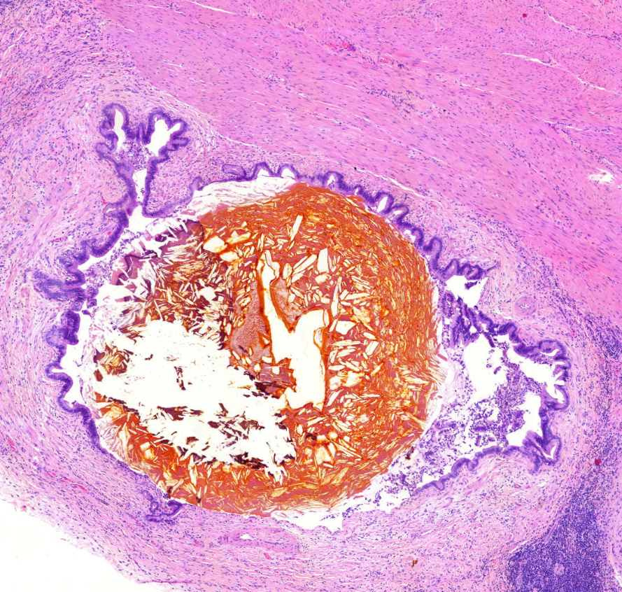 cholecystitis chronica0