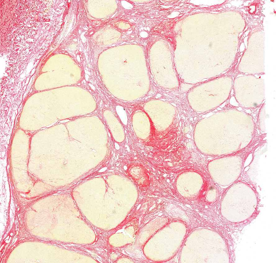 cirrhosis hepatis (picro)0