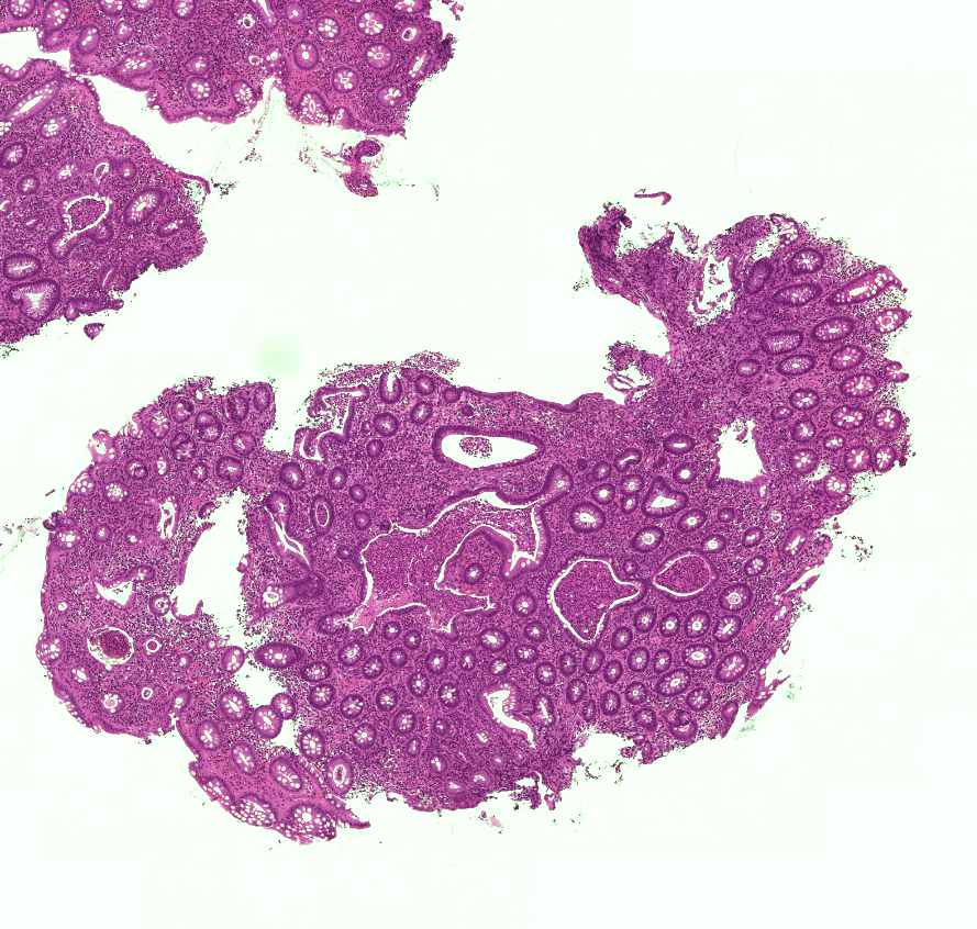 colitis ulcerosa 0