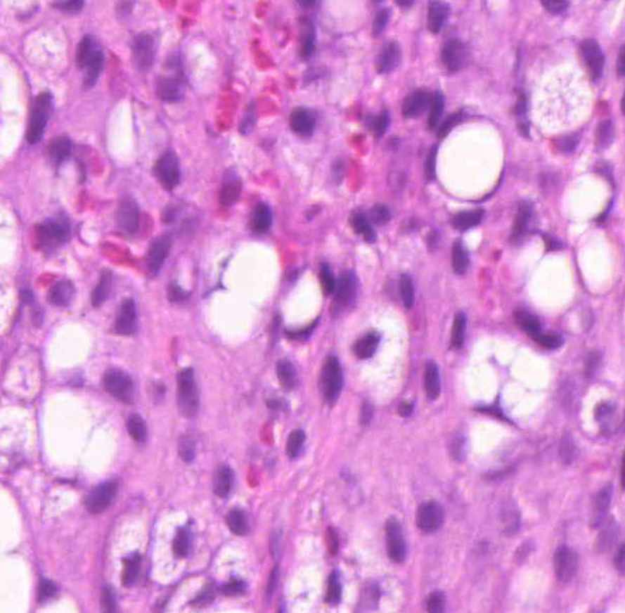 liposarcoma-lipoblast