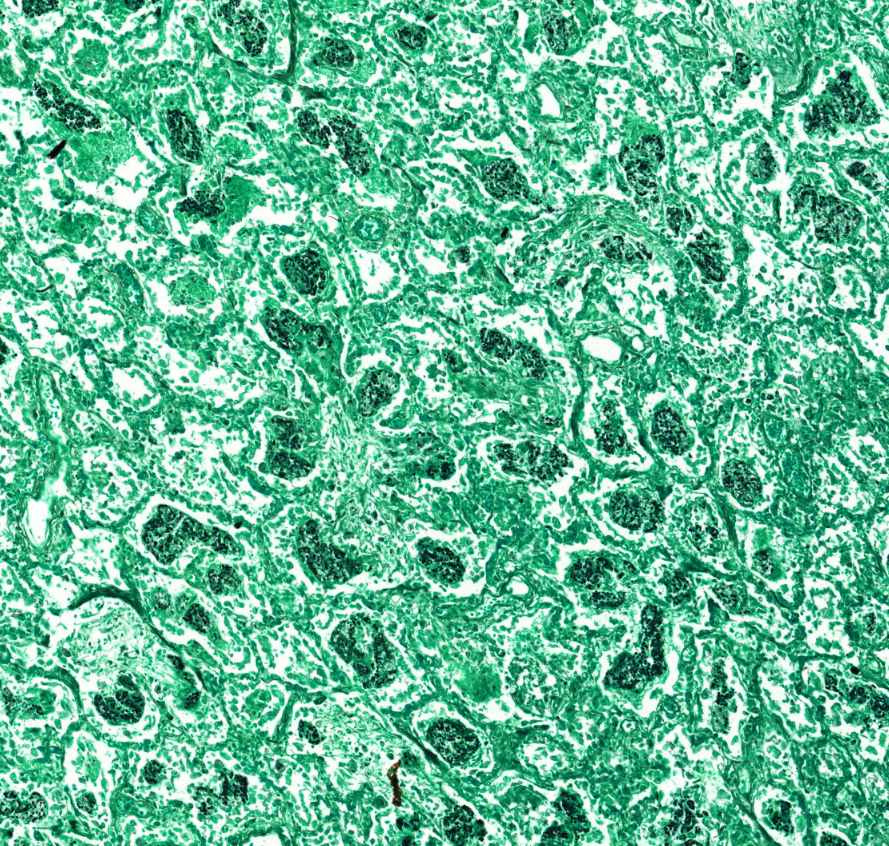 pneumocystis pneumonia (Grocott)-pneumocystic