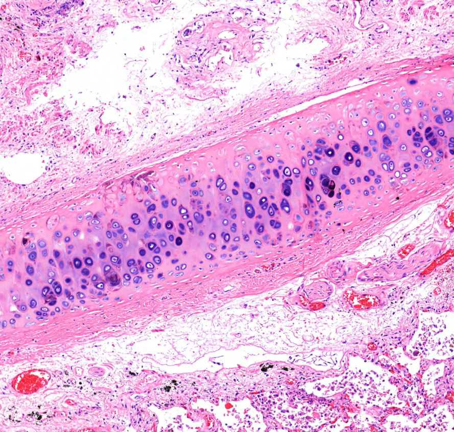 pneumocystis pneumonia0