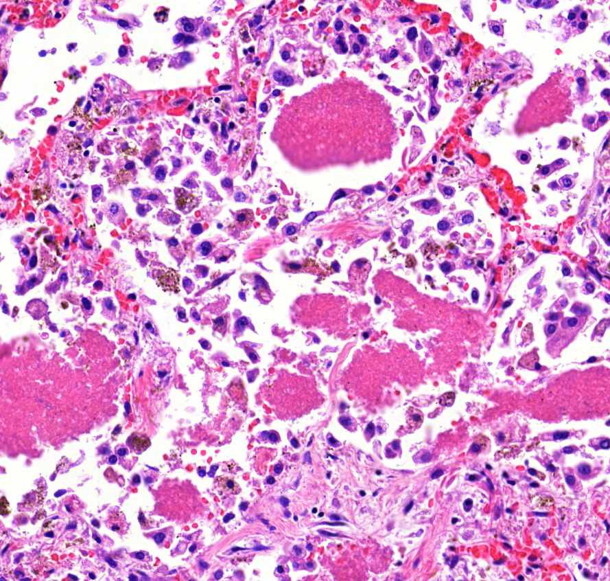 pneumocystis pneumonia-makrophagok