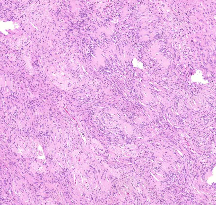 schwannoma antoni B