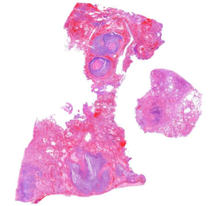 abscessus pulmonia0