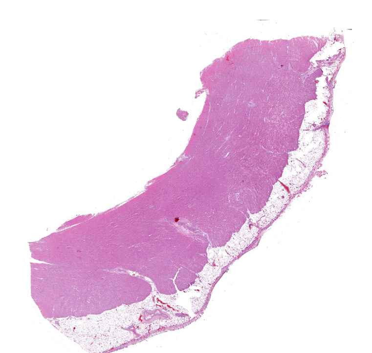 Atrophia brunea cordis-lipofuscin (and pericarditis)