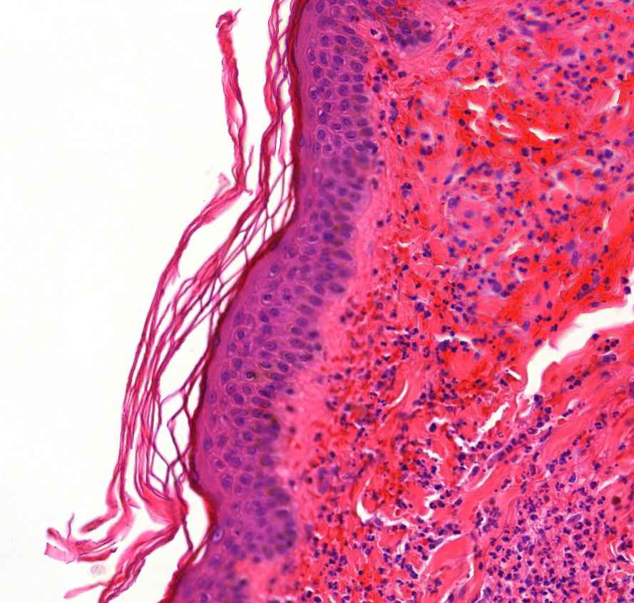 autoimmun vasculitis epidermis