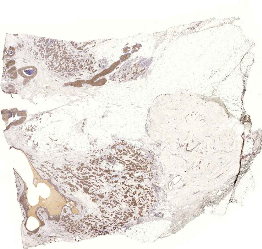 carcinoma ductale invasivum mammae (Er)