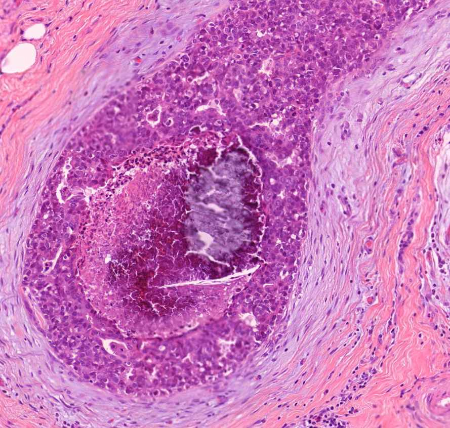 microcalcificatio carcinoma ductale in situ mammae mész=kék