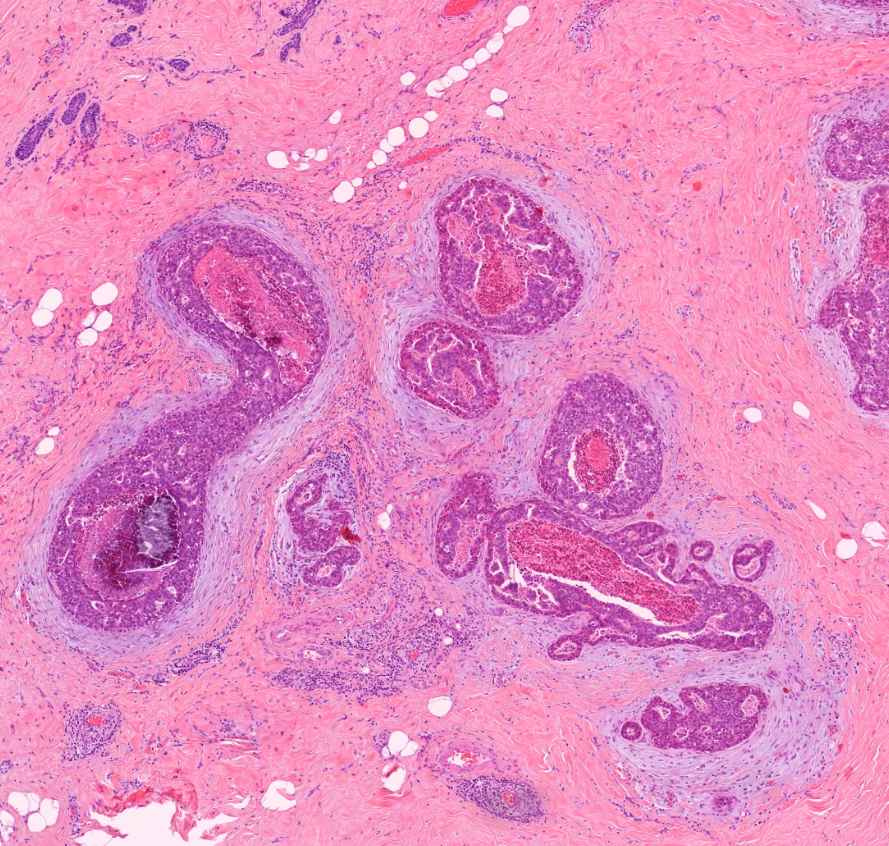 microcalcificatio carcinoma ductale in situ mammae