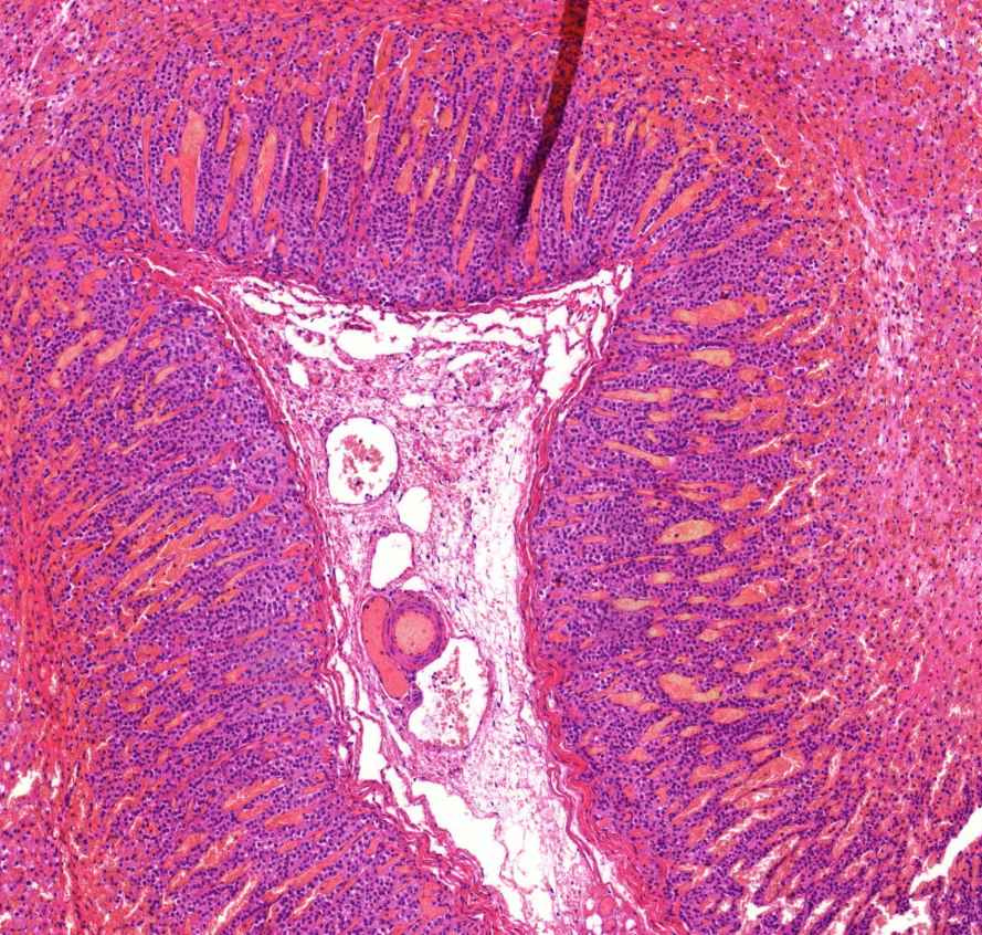 neuroblastoma0