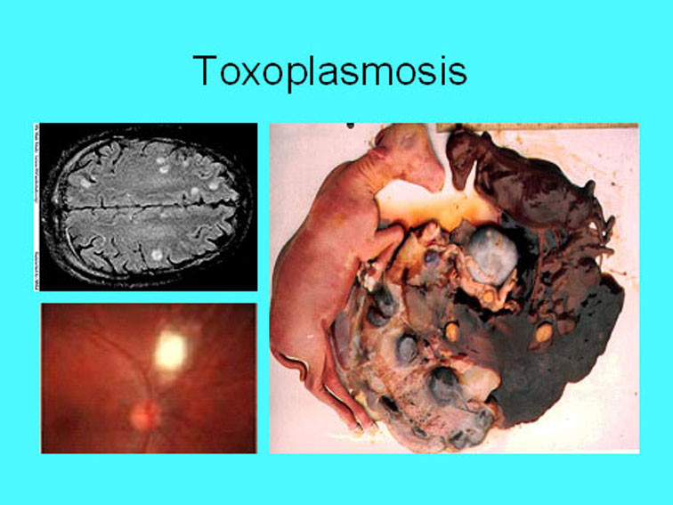 toxoplasmosis2